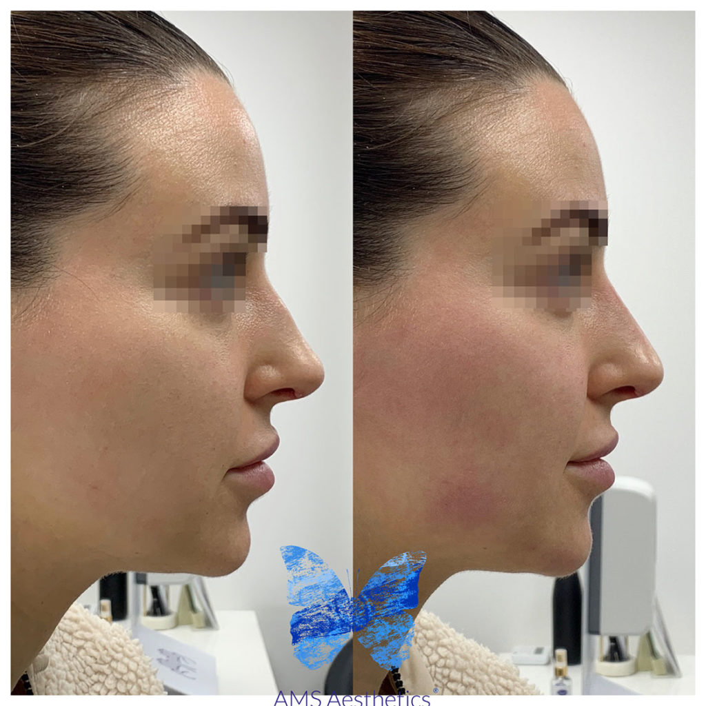 Non Surgical Rhinoplasty Ams Aesthetics Ams Aesthetics