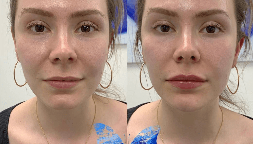 Bigger Lips - How to Get Fuller Lips