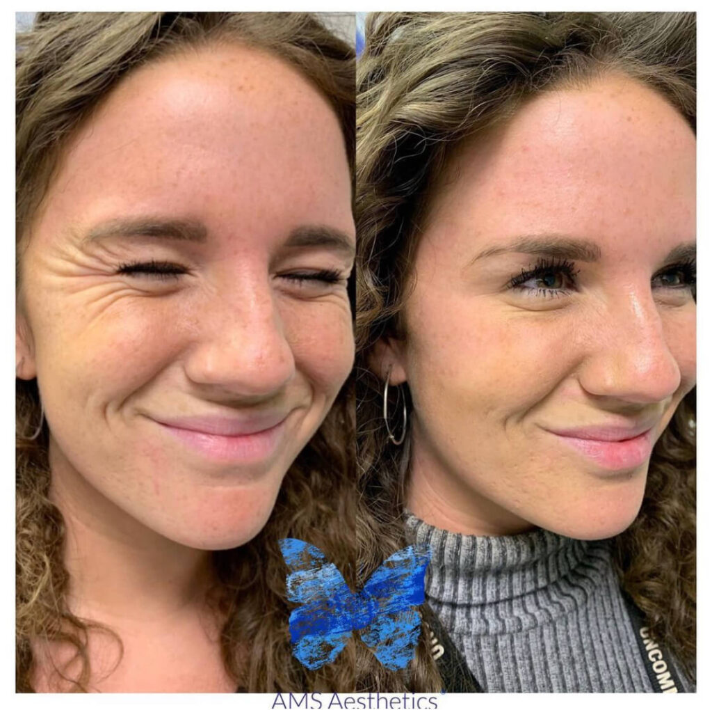 Anti Wrinkle Injections Result by AMS Aesthetics