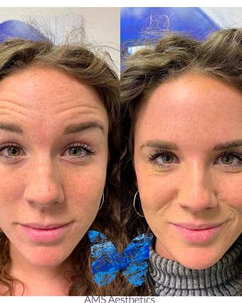 Anti wrinkle treatment before & after results