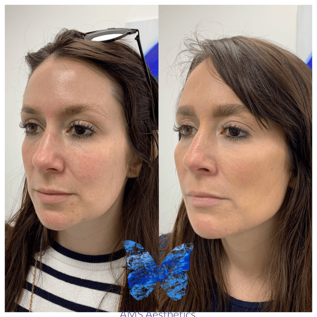 Jawline Contour Results by AMS Aesthetics