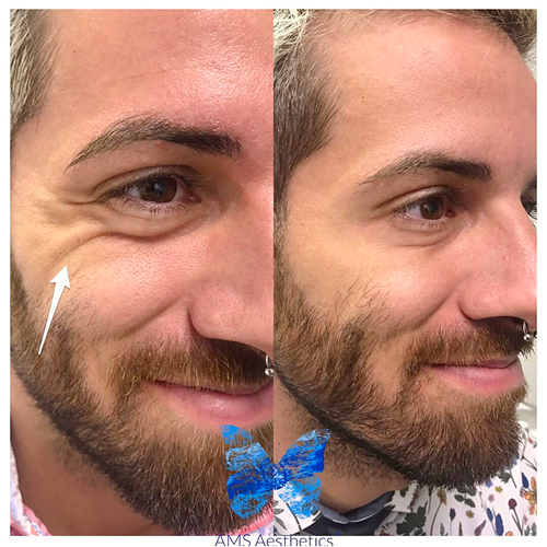 Anti wrinkle treatment before & after