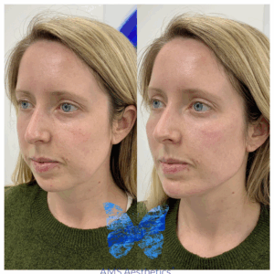 Dermal Fillers before and after jawline