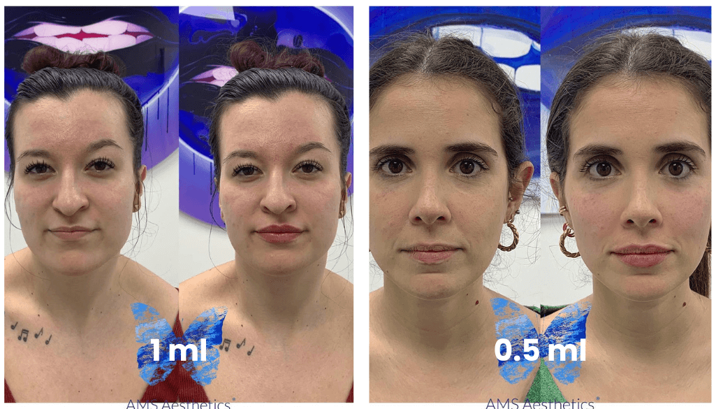 0.5ml vs 1ml Lip Filler