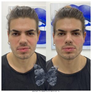 Dermal Fillers Before and after Jawline