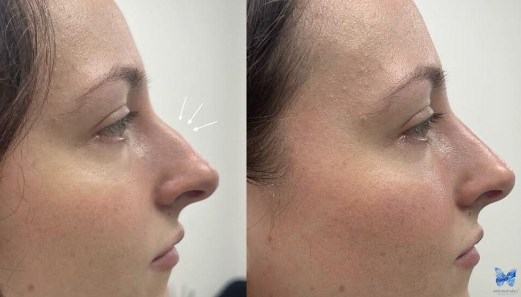 Nose Fillers before and after