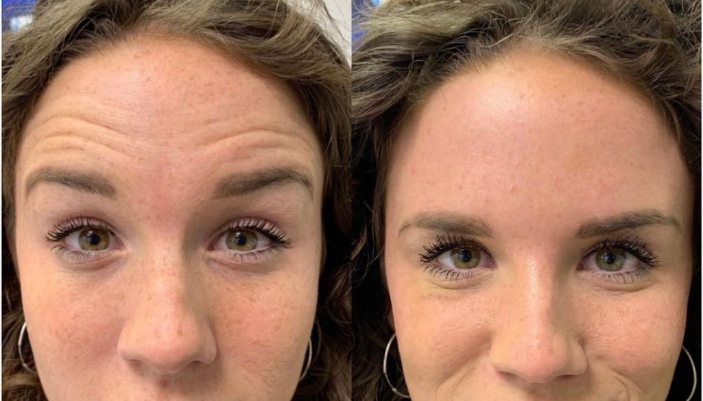How To Get Rid of Forehead Lines and Wrinkles
