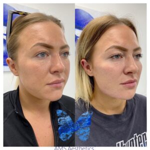 Dermal Fillers Before & After Jawline