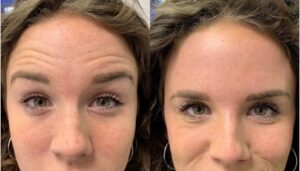 How To Get Rid of Forehead Lines and Wrinkles