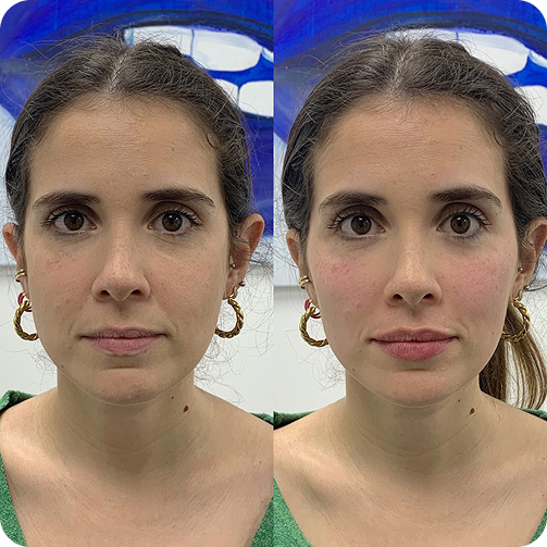 Butterfly effect treatment result by MR AMS