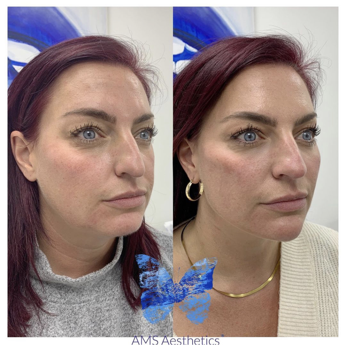 nose filler2