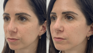 Full Facial Rejuvenation Result by Mr AMS