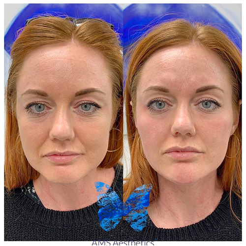 Before and after full face contouring and volume restoration