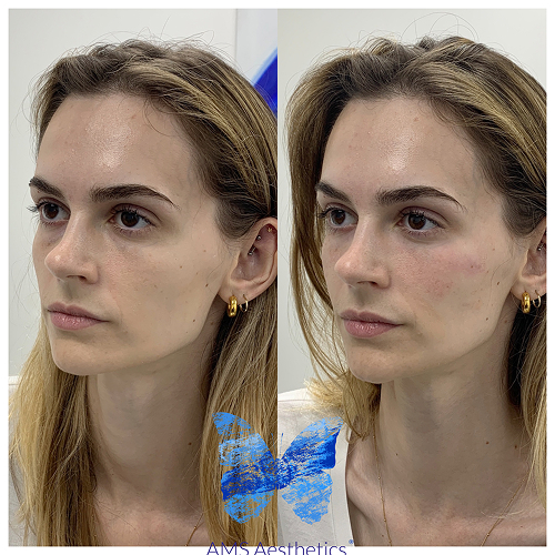 Full Face rejuvenation Before & After Result By AMS Aesthetics