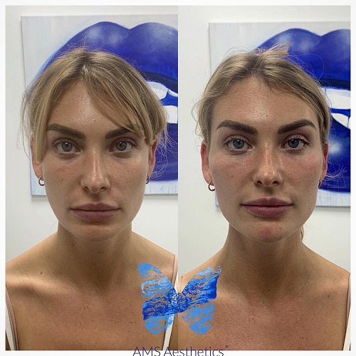 Full Face rejuvenation Before & After By AMS Aesthetics