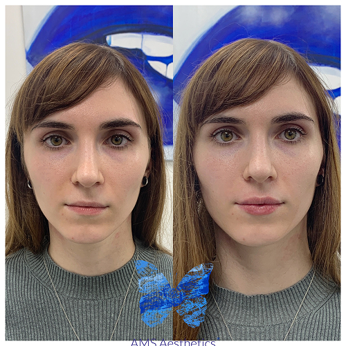 Full Face rejuvenation Before & After Results
