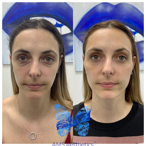 Full Face rejuvenation Before and after