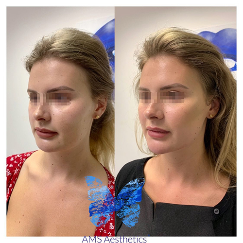 Full Face Rejuvenation Before & After by AMS Aesthetics