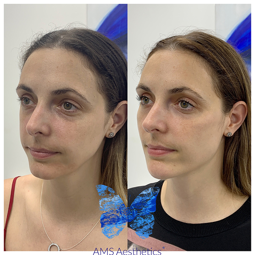 Full Face rejuvenation Result