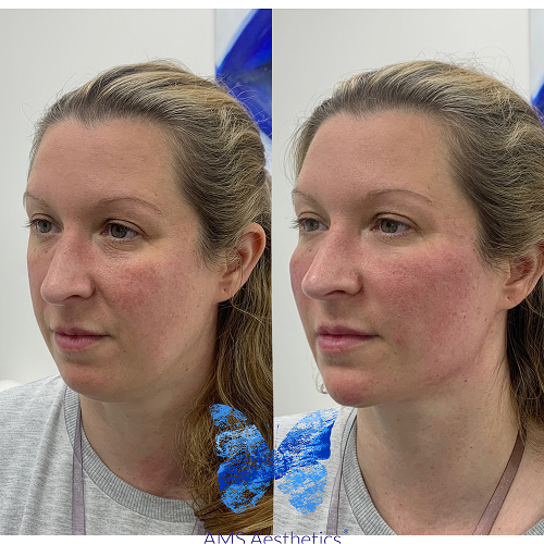 Full Face rejuvenation Result by AMS