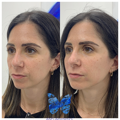 Full Face Rejuvenation Before & After by AMS