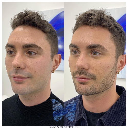 Full Face Rejuvenation Before & After by AMS