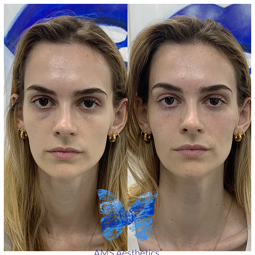 Facial contouring with full face rejuvenation – patient results
