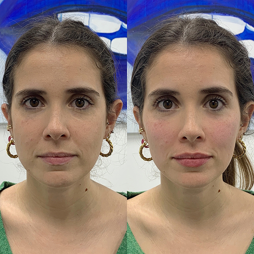 Full face rejuvenation with natural results - before & After