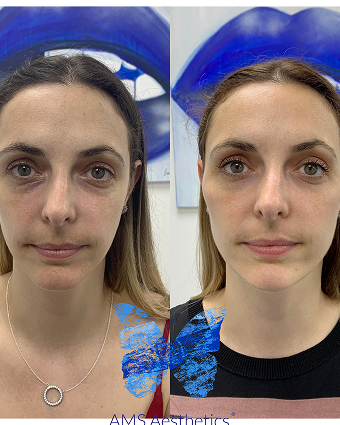 Full face rejuvenation before and after by Mr AMS