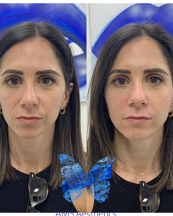 Full face rejuvenation Result