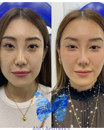 The Butterfly Treatment Effect Result