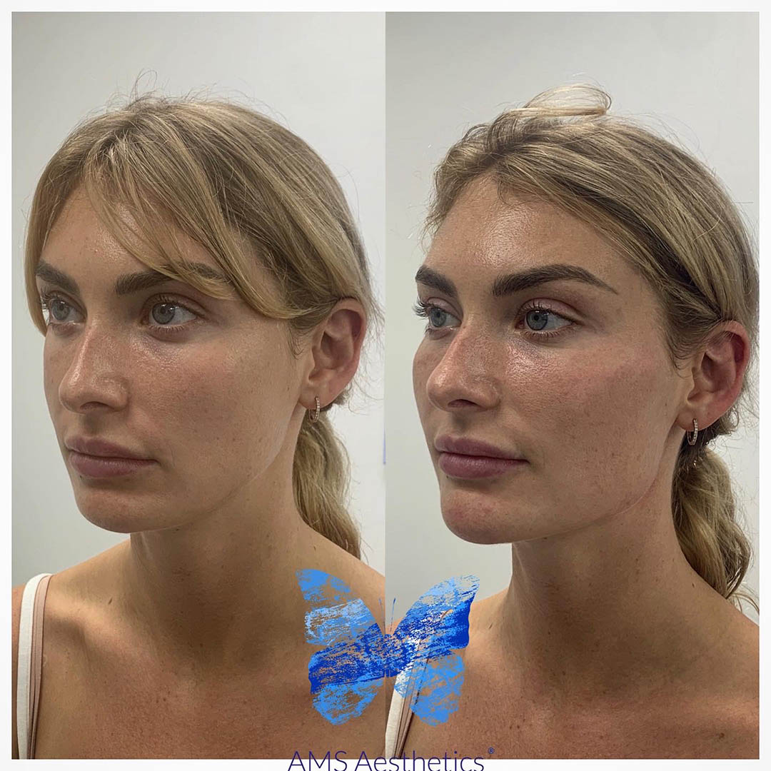 Cheek Filler Before and After