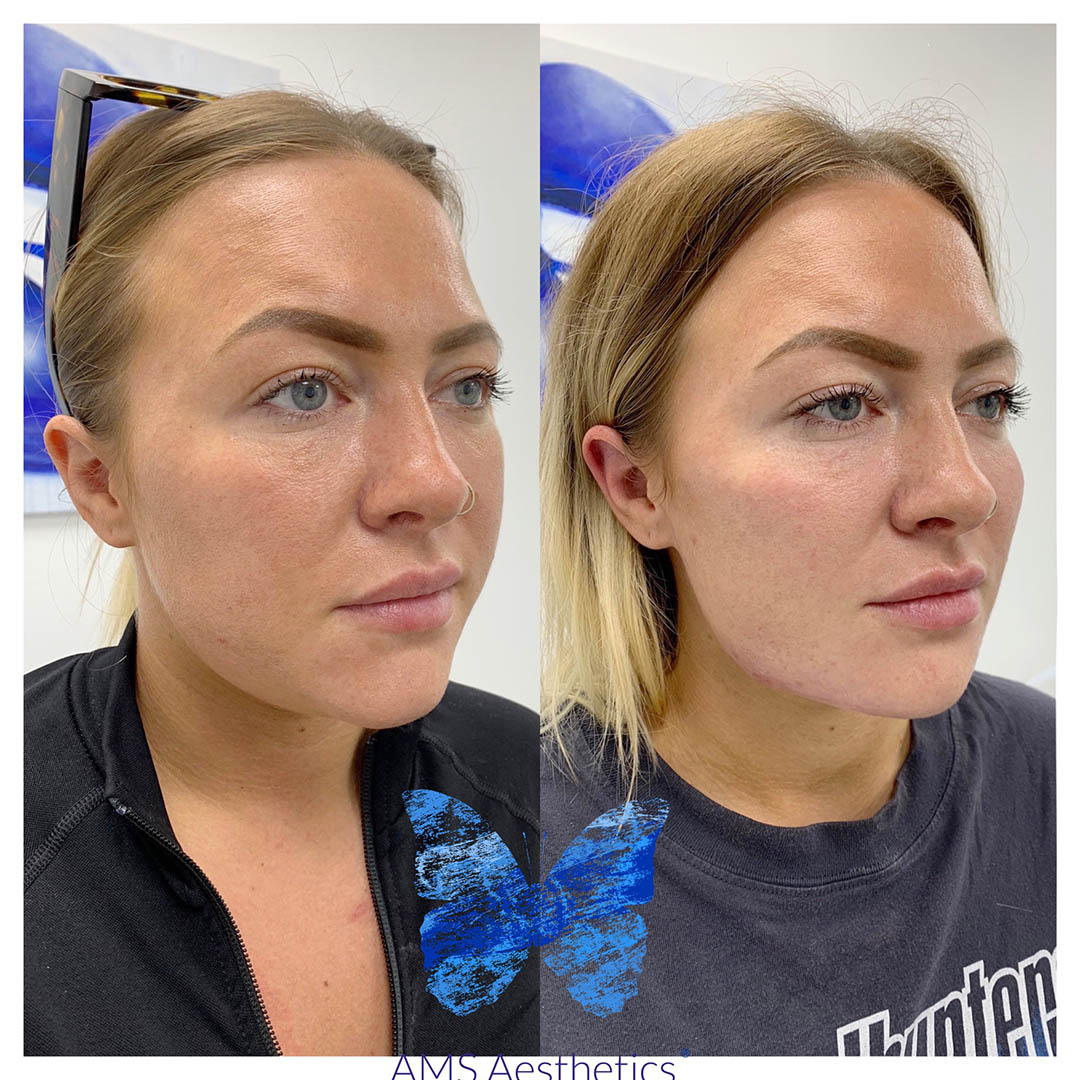 Cheek Filler Before and After by AMS Aesthetics