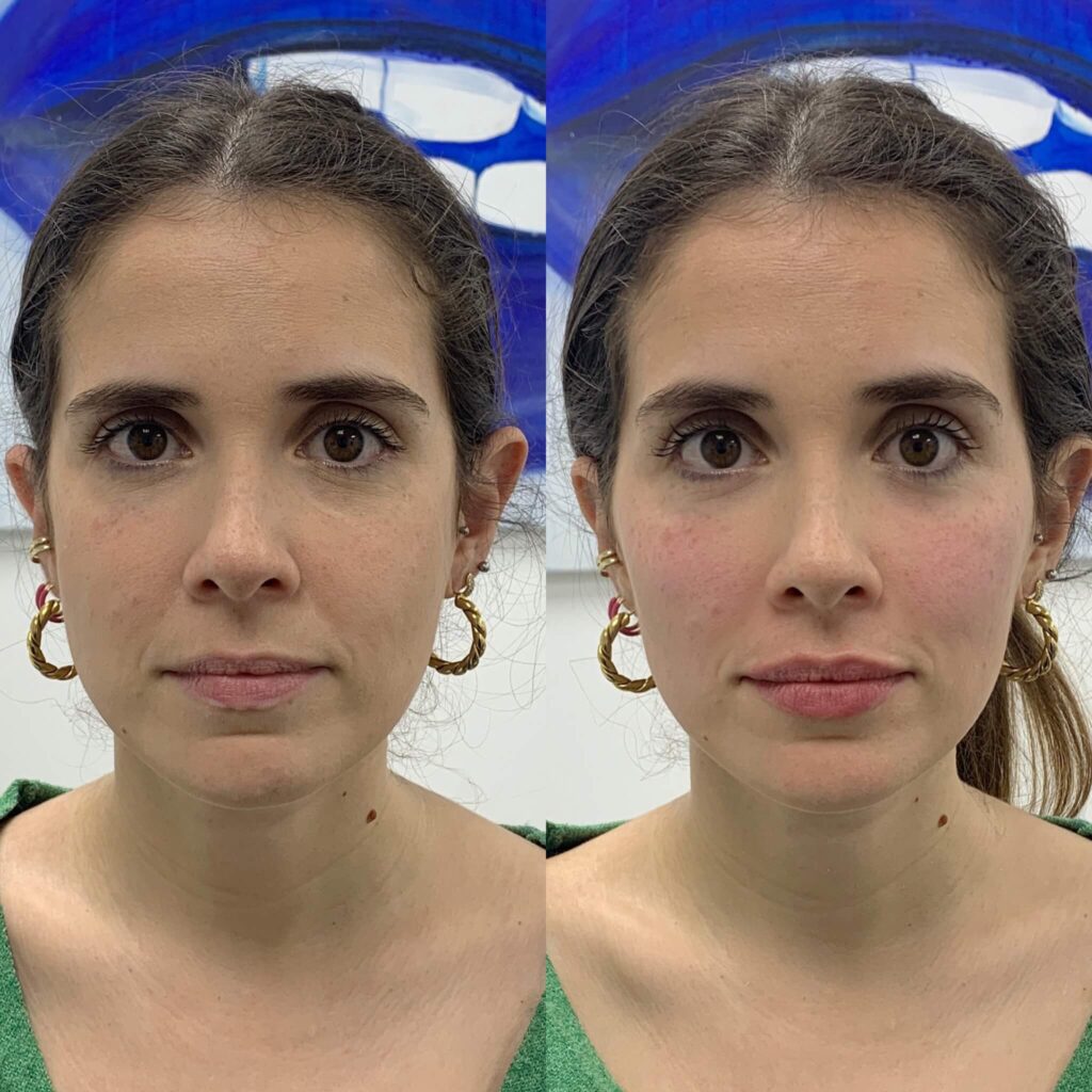 Butterfly effect treatment result by AMS Aesthetics