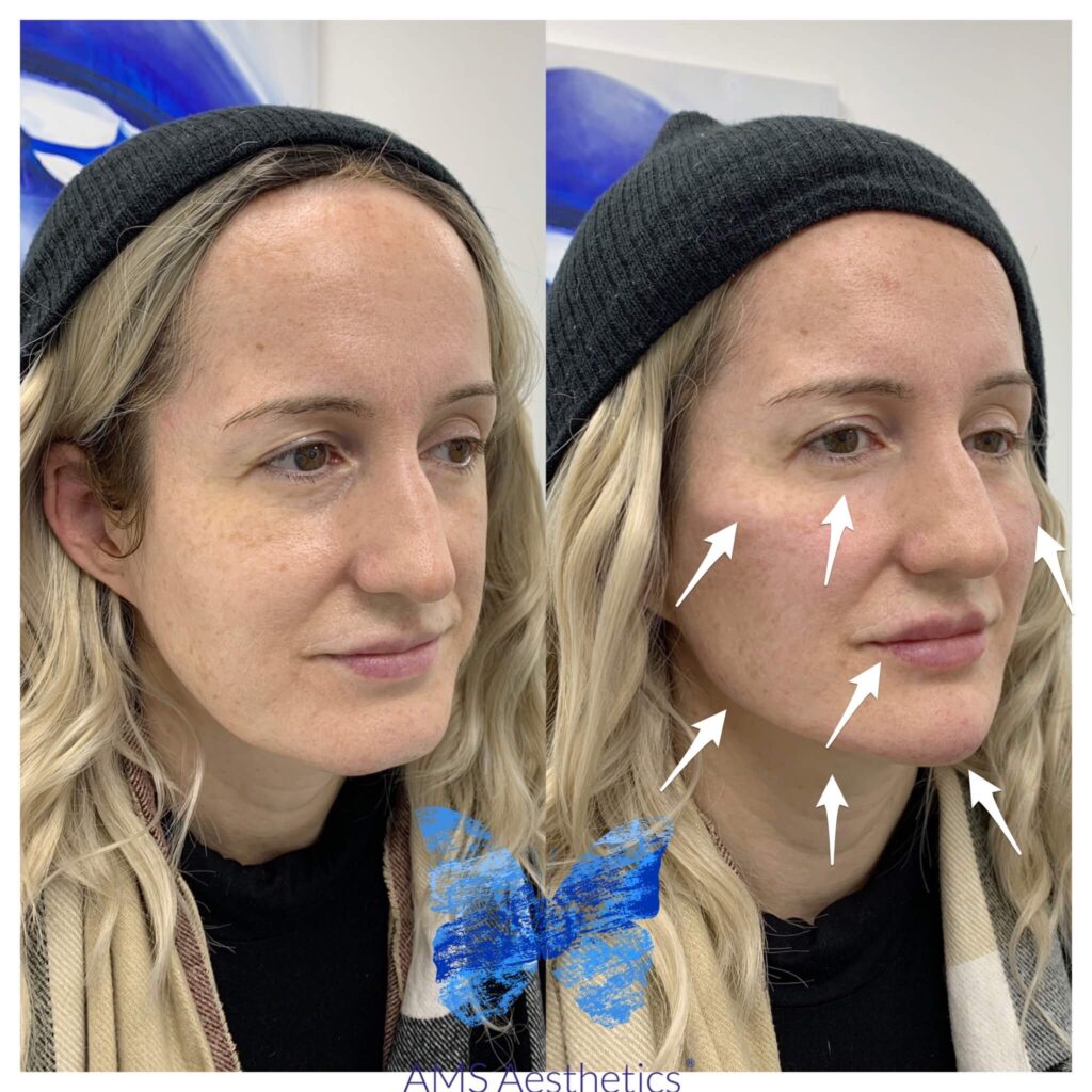 Full face Rejuvenation before and after by AMS Aesthetics