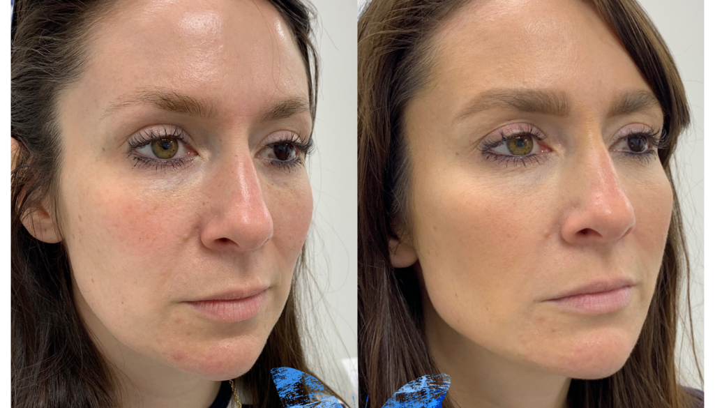 How to Fix Asymmetrical Face