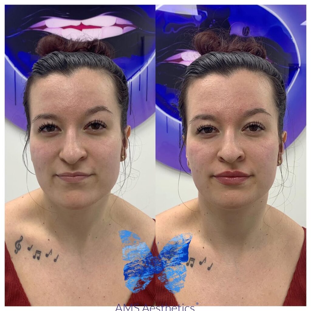 1 ml Lip Filler Before and After