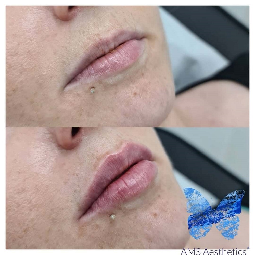 1ml Lip Filler Before & After