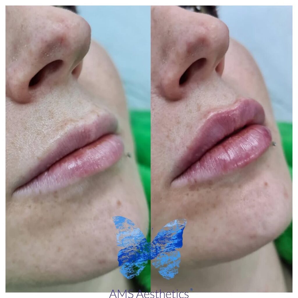 1ml Lip Filler Before and after thin lips