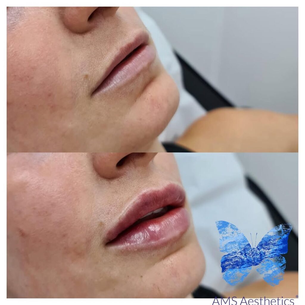 1ml lip injections before and after