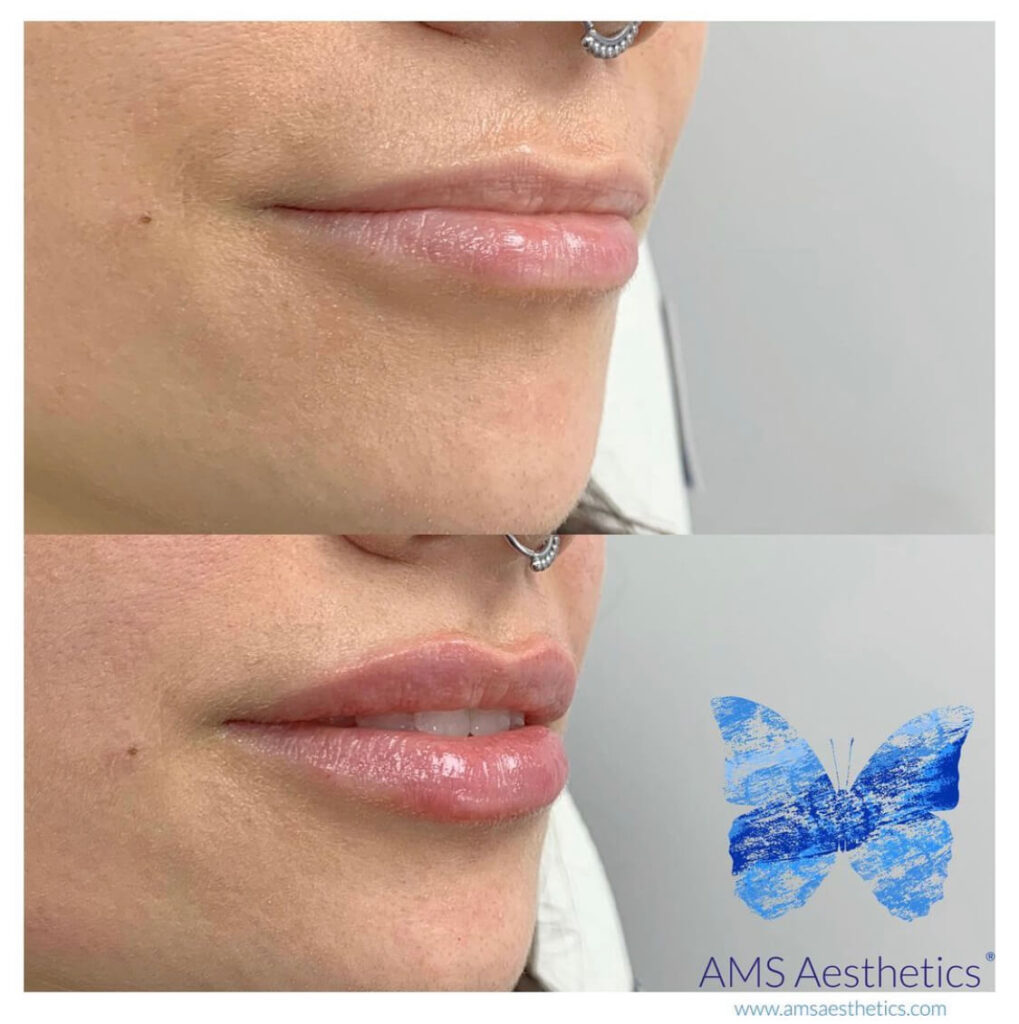 Asymmetrical Lips Before & After