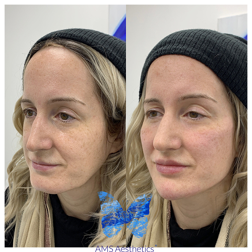 Full Face rejuvenation Before & After Result By AMS Aesthetics