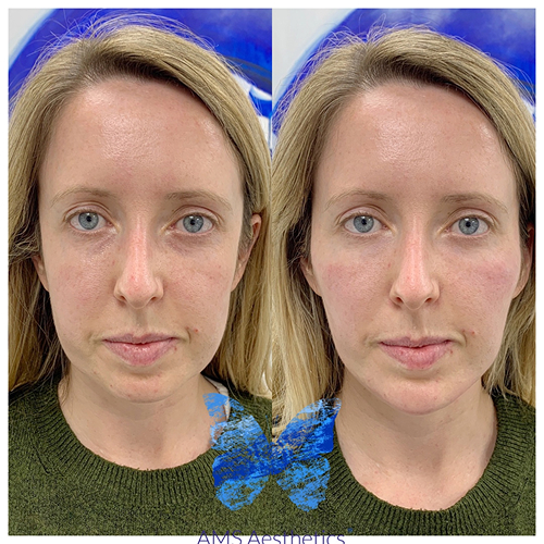 Facial balancing results from full face rejuvenation treatment