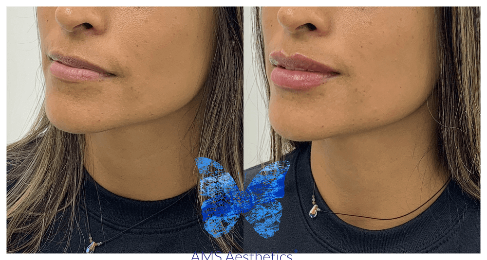 Cupid bow lip filler Results