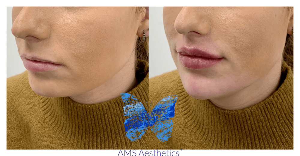 Cupids Bow LIp Filler before and after