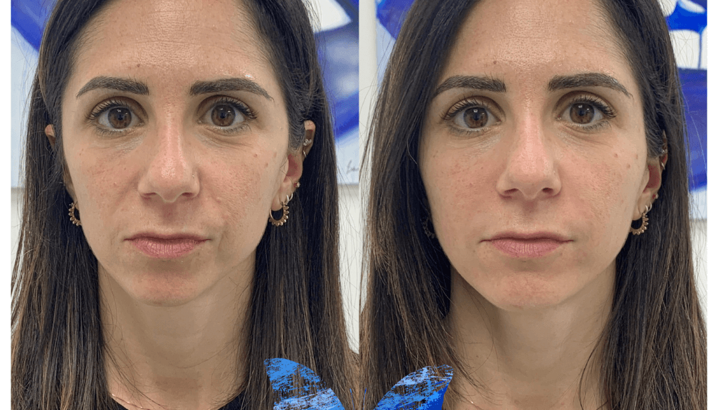 Facial Contouring by butterfly Effect treatment