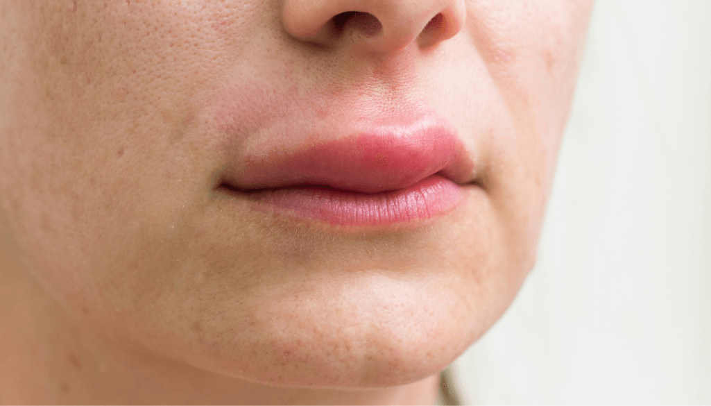 How Long Does Swelling Last