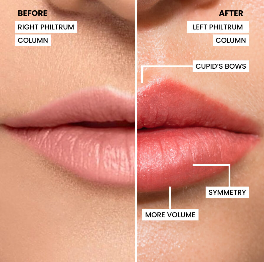 How lip filler enhance lip shape