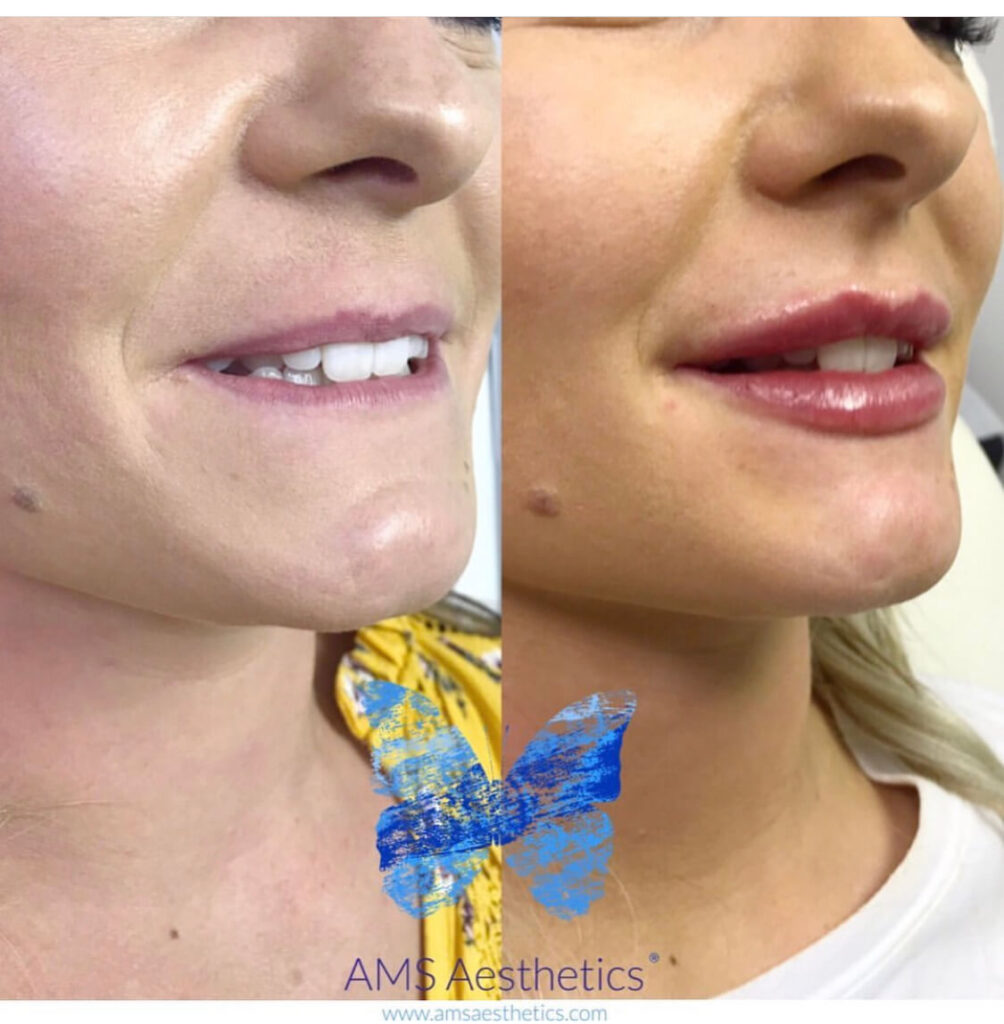 Lip filler final result stage