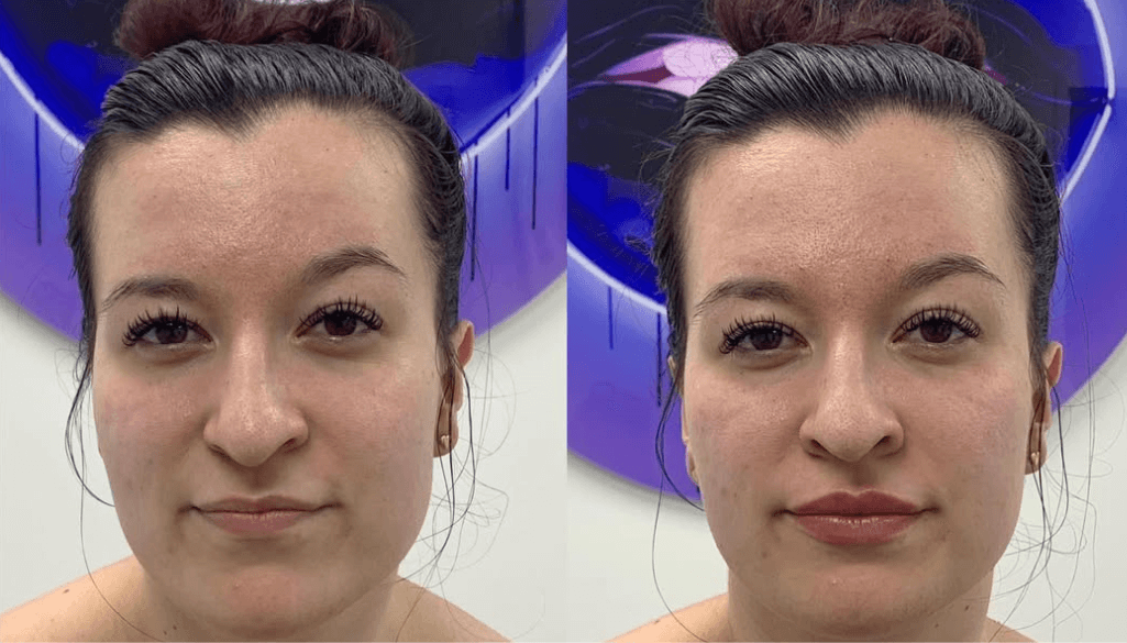 Realistic 1ml lip Filler before and after thin lips